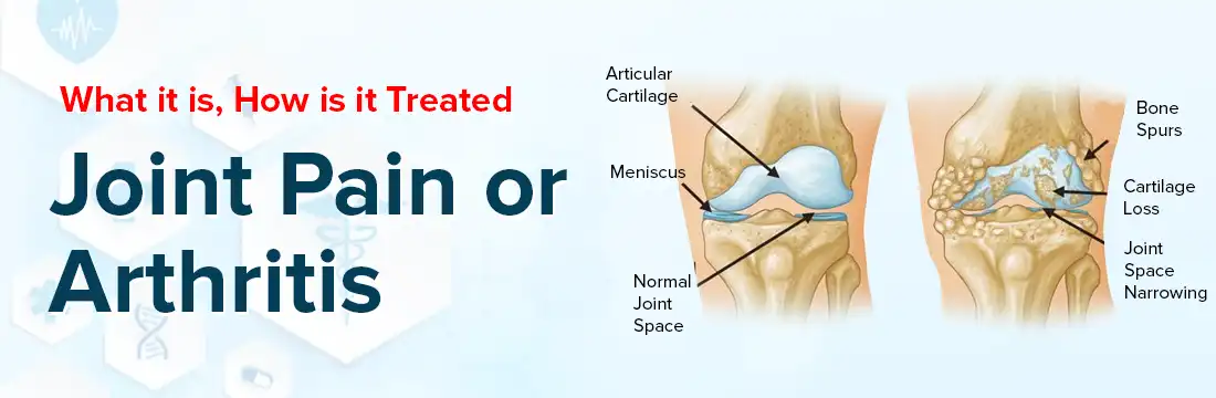 Joint Pain or Arthritis: What it is, How to Know and How is it Treated